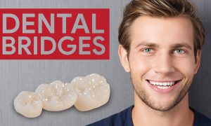 missing tooth bridge 