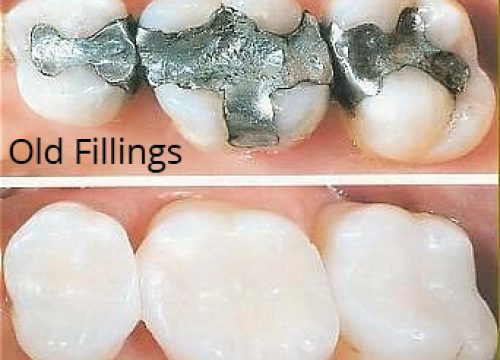 tooth colored fillings and composites