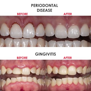 Periodontal and Gingivitis before and after