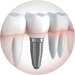 Dental Implants Diagram 