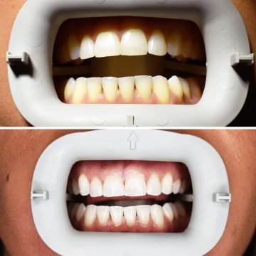 Teeth Whitening in Memphis