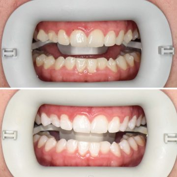 Memphis Teeth Whitening before and after