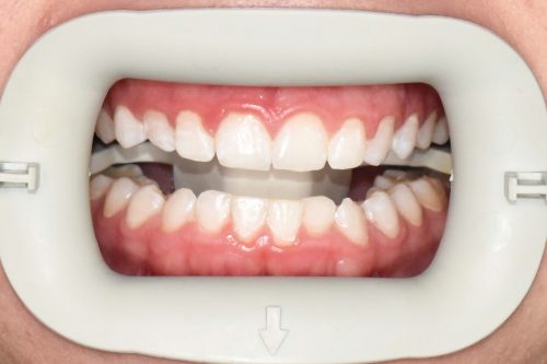 Boost Whitening After Photo