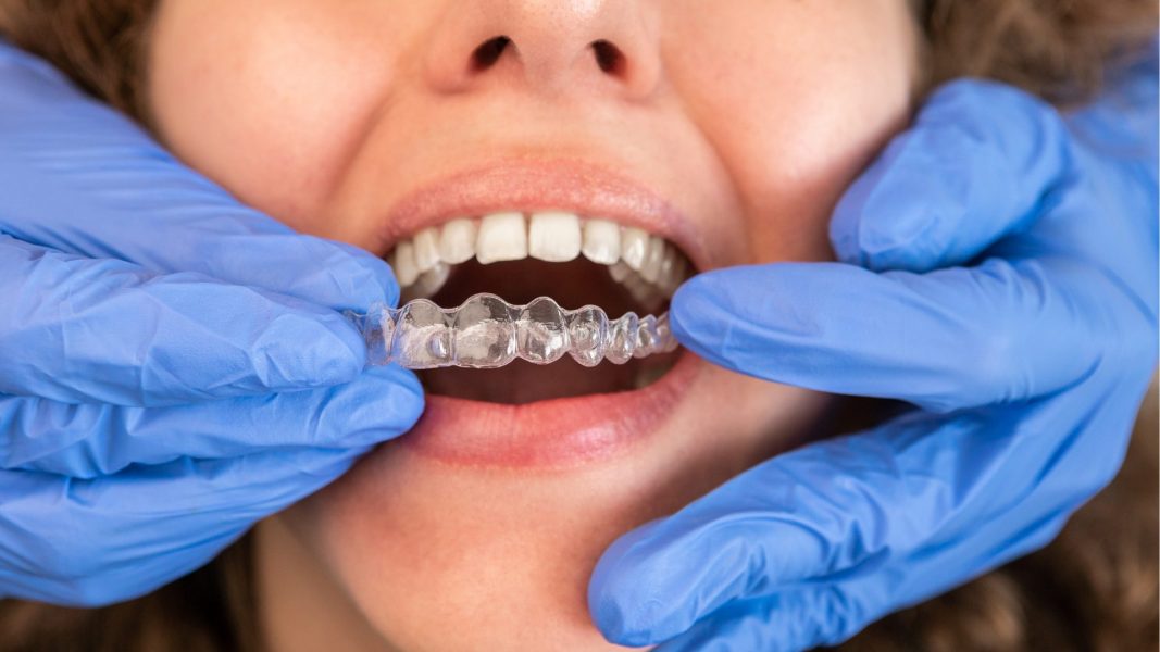 Dentist Placing Invisalign