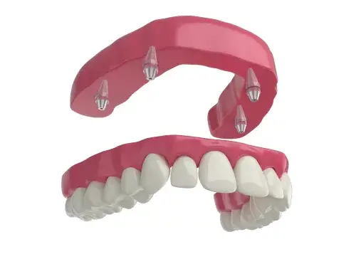 Implant Denture