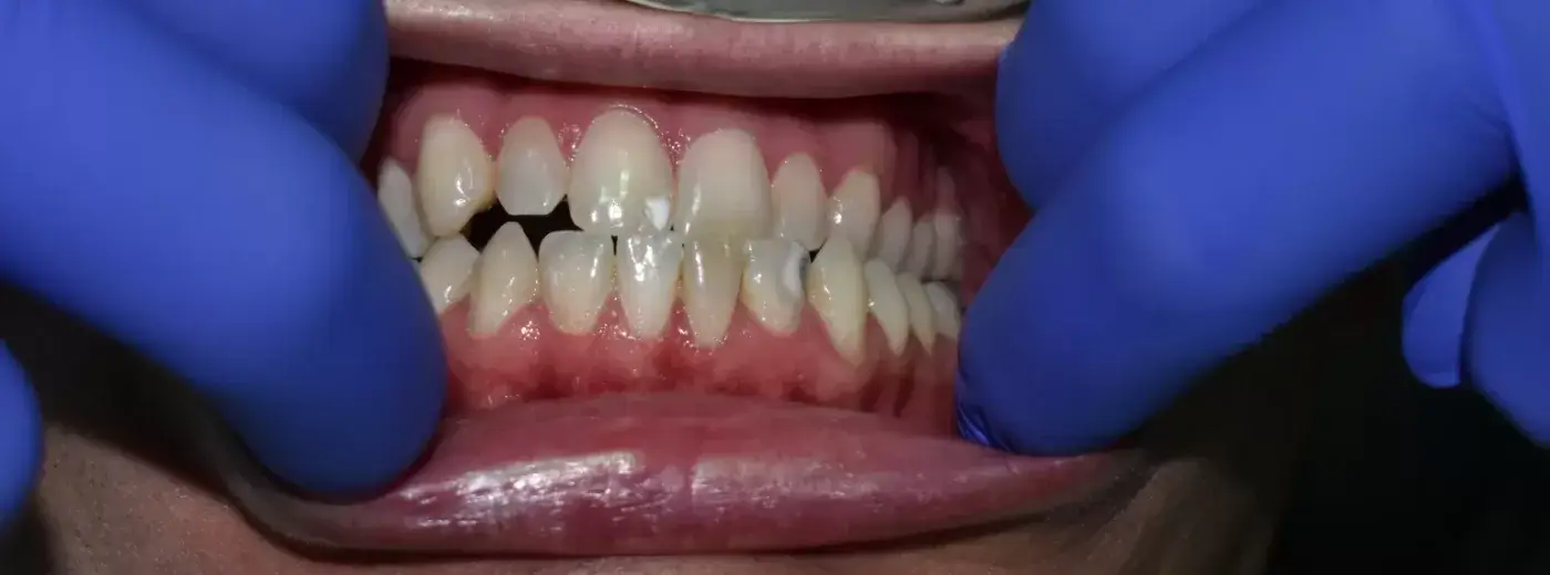 Before after smile