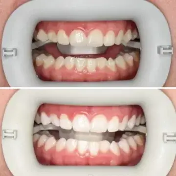 Boost Whitening Before and Afters