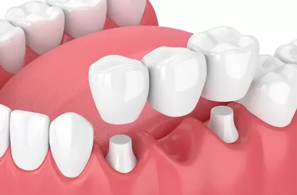 dental bridge