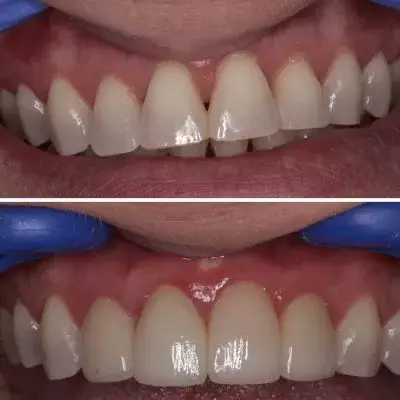 veneers in memphis