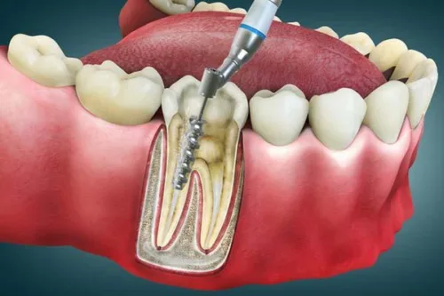 root canal treatment